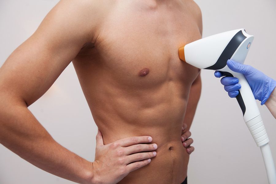 depilación láser masculina